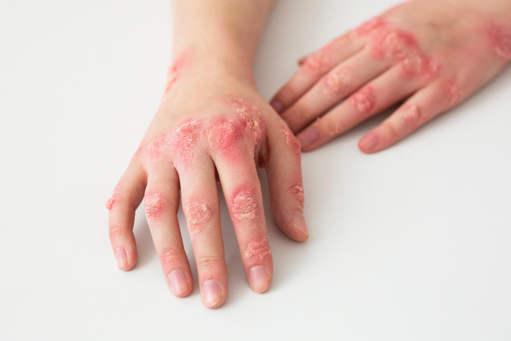 التعرّف على مرض القوباء (Impetigo) لدى الأطفال: الأسباب، الأعراض، العلاج، وطرق الوقاية